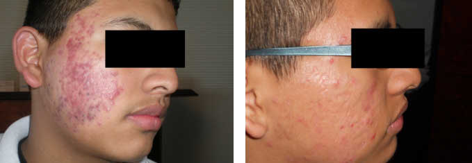 risultati acne